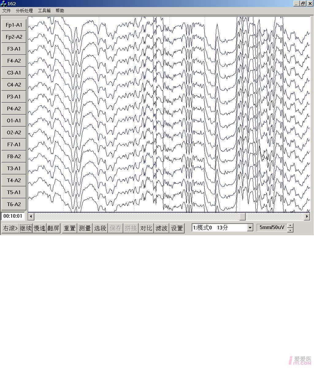 脑电图求教