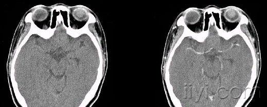 五官眼部部分疾病ct图片
