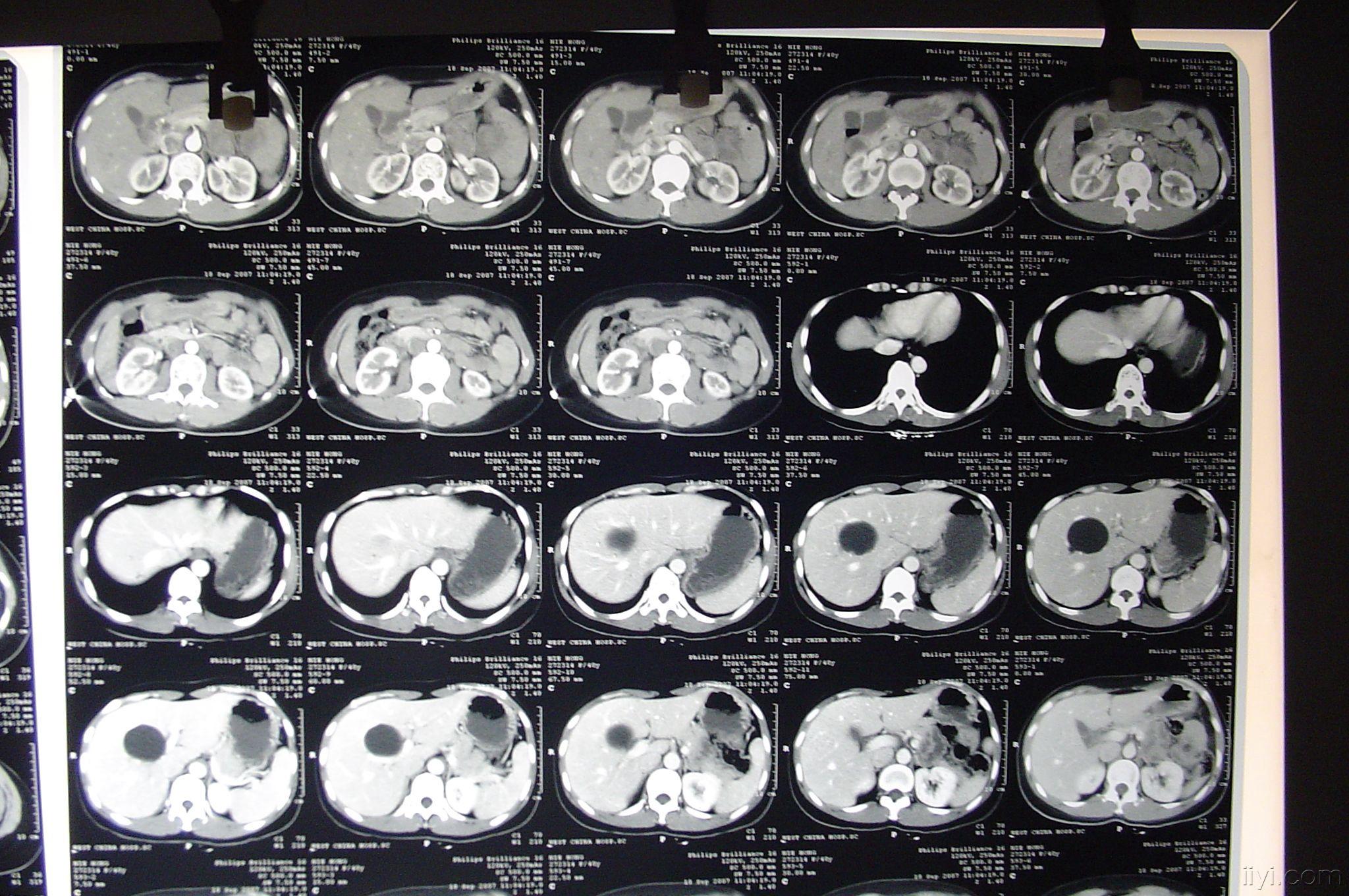 讨论--位于肝门静脉的囊肿治疗方案  ct