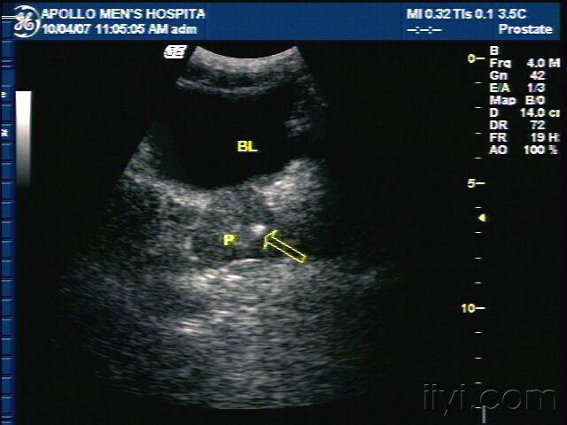 典型——精囊腺囊肿!欢迎参与前列腺钙化与结石的讨论