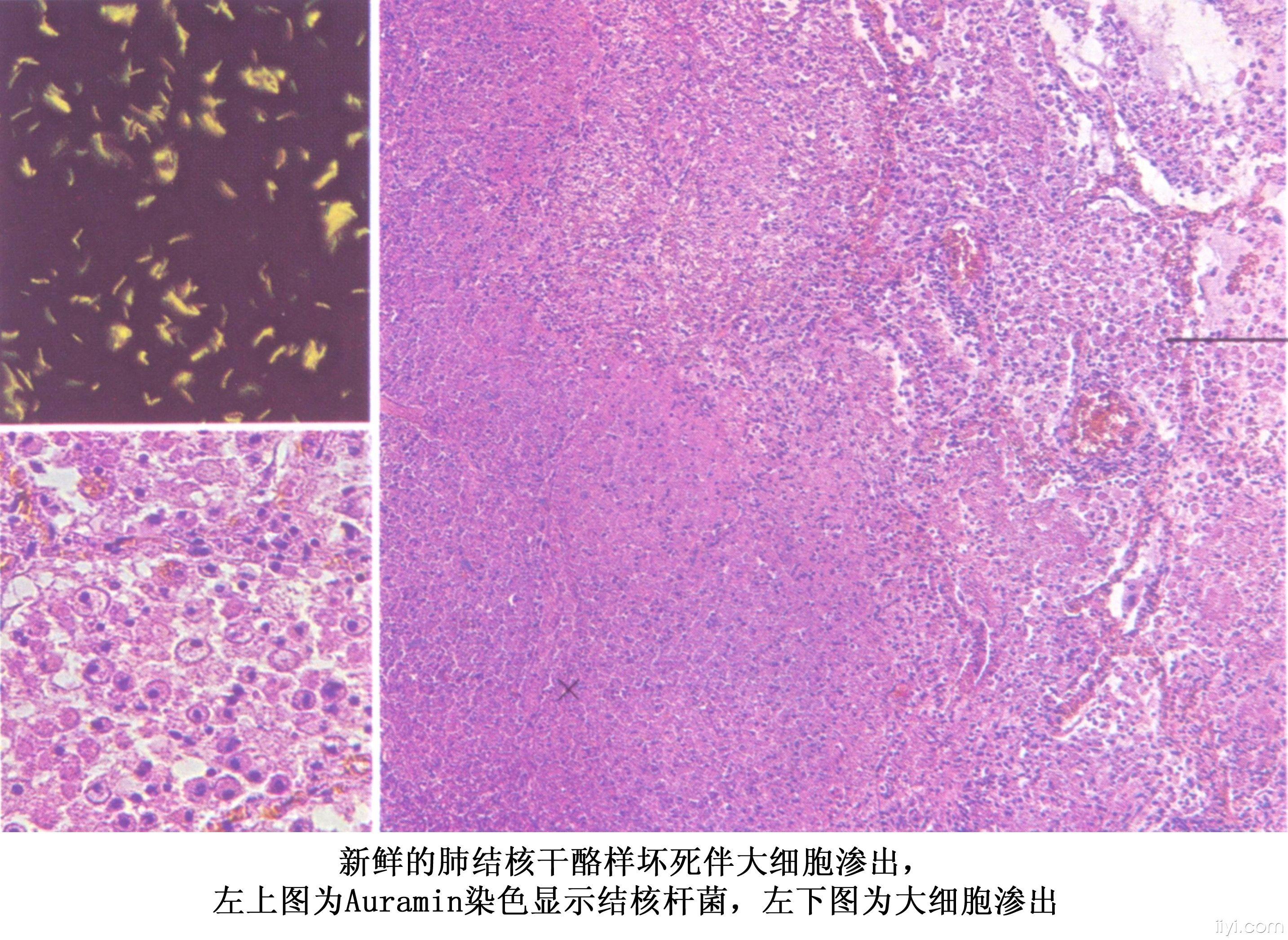 【贴图】结核的病理图片,病理标本