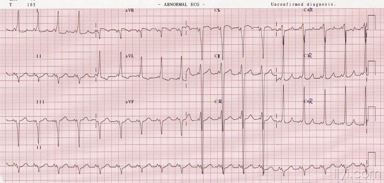 [心电图分析] 欣赏
