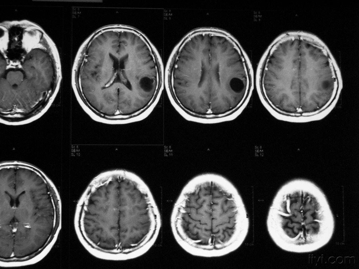 影像学每周一病之2-----脑囊虫病