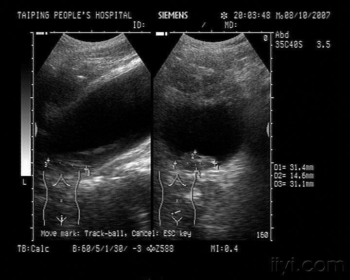 膀胱内血块并膀胱小结石 - 超声医学讨论版 - 爱爱医医学论坛