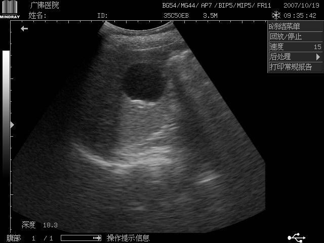 肝囊肿 - 超声医学讨论版 - 爱爱医医学论坛