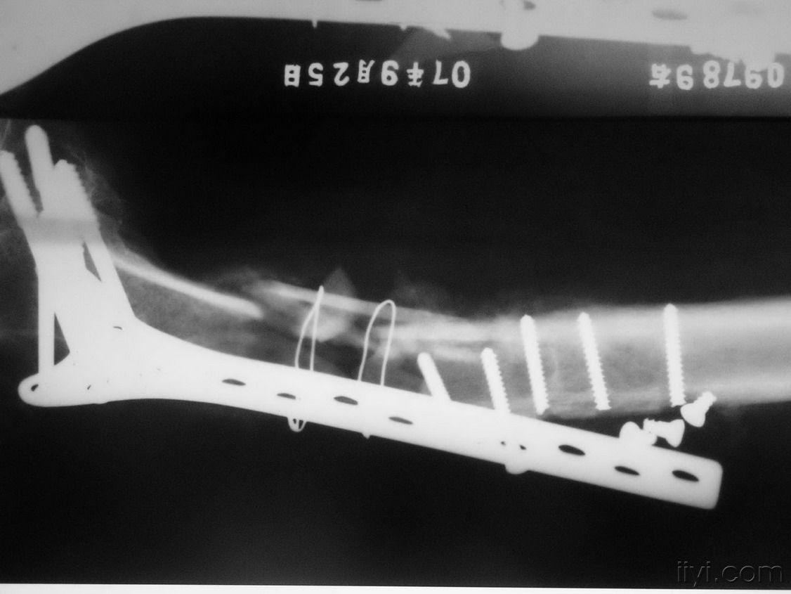 股骨髁上骨折钢板内固定术后螺钉断裂伴骨髓炎