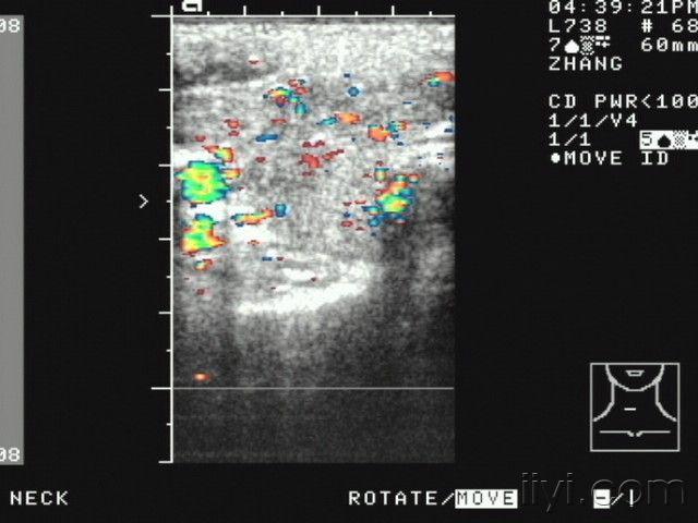 典型的甲状腺超声声像图 - 超声医学讨论版 - 爱爱医医学论坛