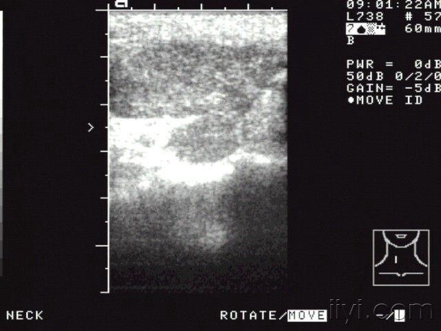 典型的甲状腺超声声像图
