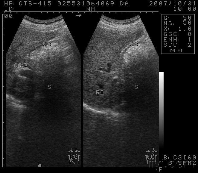 胆囊充满型结石? - 超声医学讨论版 - 爱爱医医学论坛