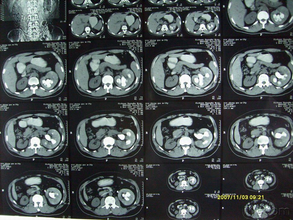 髓质海绵肾一例,大家共同学习
