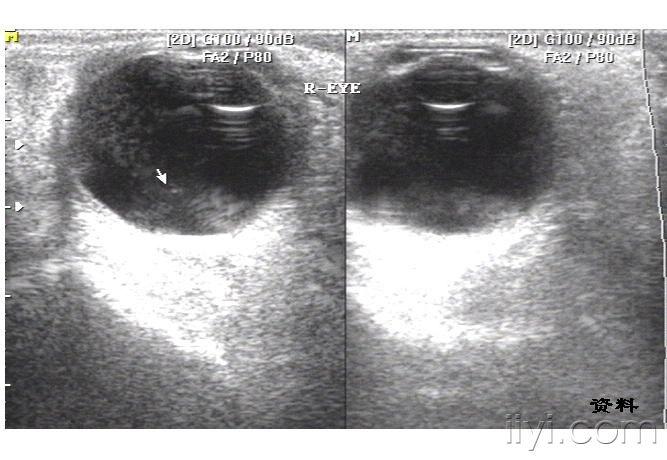 双眼玻璃体机化物合并昨眼视网膜脱离 超声医学讨论版 爱爱医医学