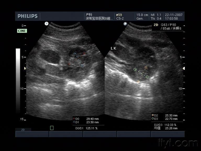 肾结核?随访中 超声医学讨论版 爱爱医医学论坛