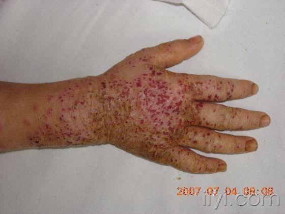 也有称疱疹性湿疹或种痘性湿疹