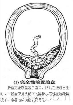 第十八期学术专题讨论 :胎盘早剥和前置胎盘