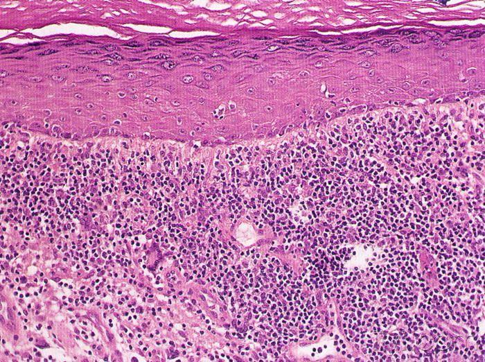 f 苔藓样药疹 炎性浸润中常混有少量嗜酸性粒细胞,有时含浆细胞