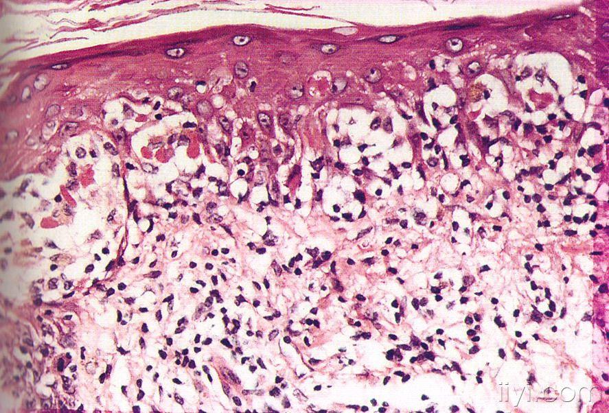 皮肤病理3炎症性皮肤病苔藓样组织反应模式a