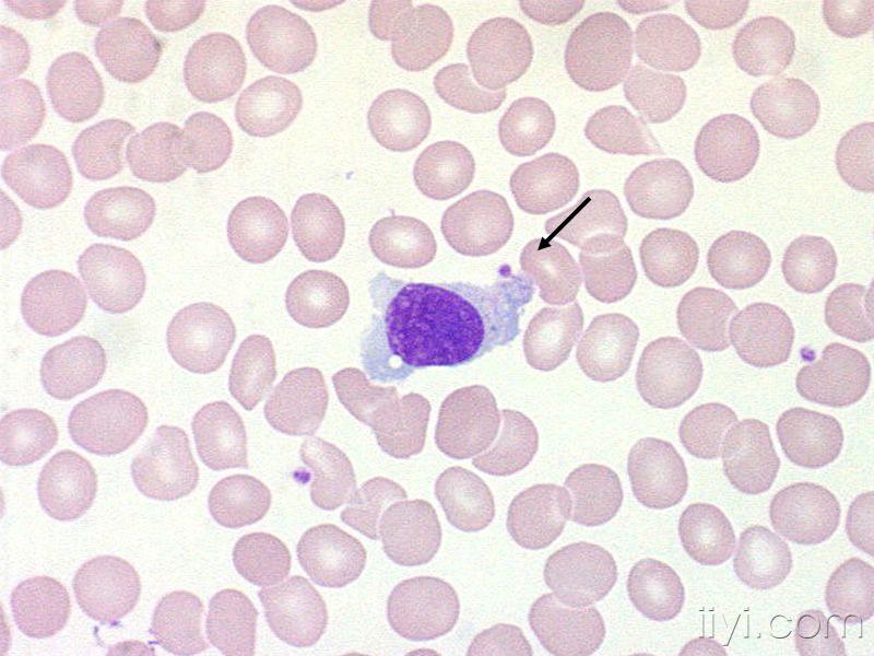 日本血液学会的异型淋巴细胞图片