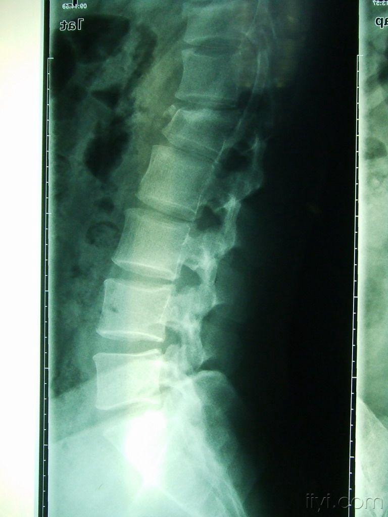 l1椎体压缩性骨折