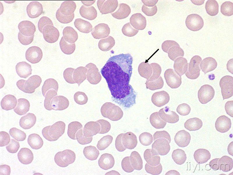 日本血液学会的异型淋巴细胞图片