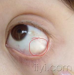 大家帮我看看啊,我朋友的眼睛球结膜上长了个肿块,如图,疑似睑裂斑