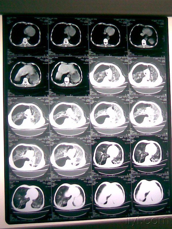 这样的肺大泡,手术预后如何?(附图)