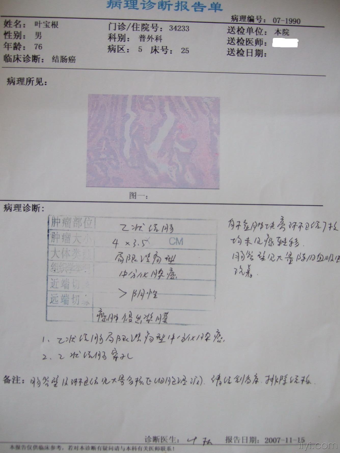 病人诊断:急性弥漫性腹膜炎,乙状结肠息室穿孔,结肠癌(直乙交界处