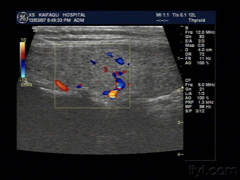 这种甲状腺应该怎么诊断 - 超声医学讨论版 - 爱爱医