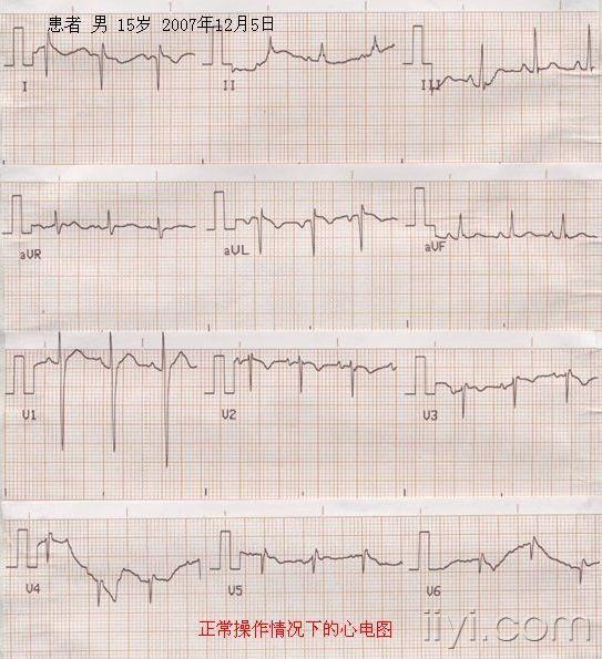 右位心心电图