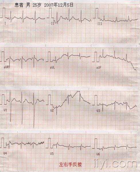 右位心心电图