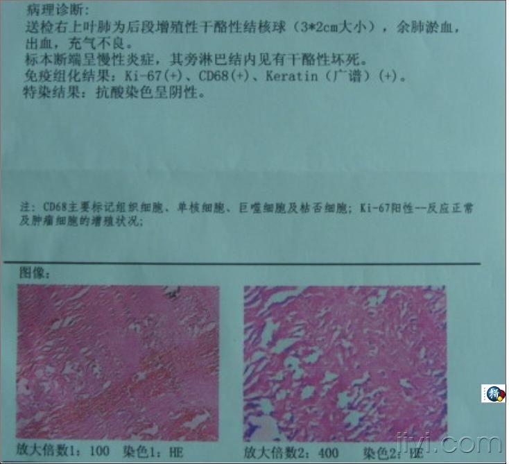 病人 男 33岁 痰中带血丝1个月(有病理20071205公布)