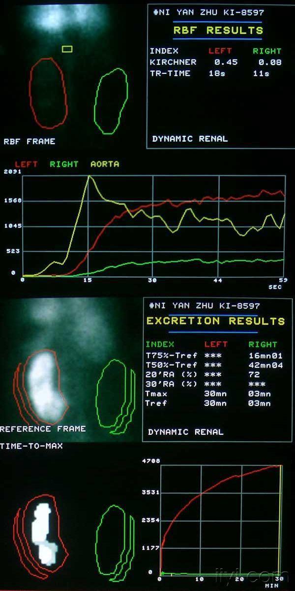 法国sopha-dsx型spect肾图,左肾区可见核素代谢曲线,右肾区未见核素