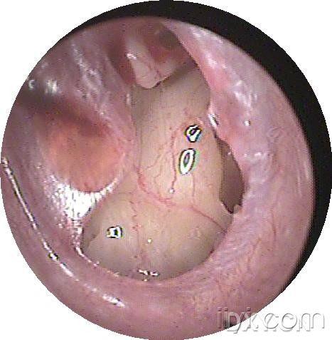 外伤性鼓膜穿孔,4个并外耳道前壁骨瘤
