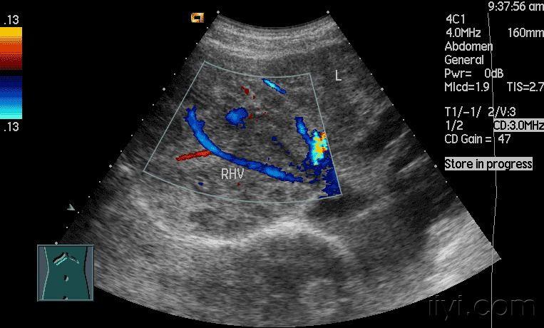 肝脏超声讲座