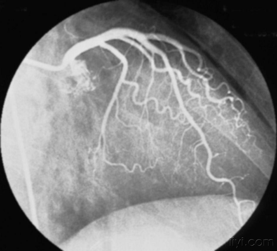 图4-15-正常左冠状动脉造影.jpg
