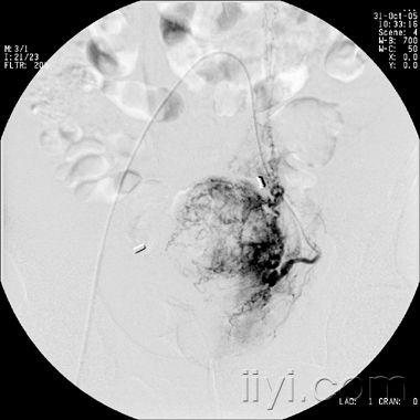 宫颈癌介入治疗图片