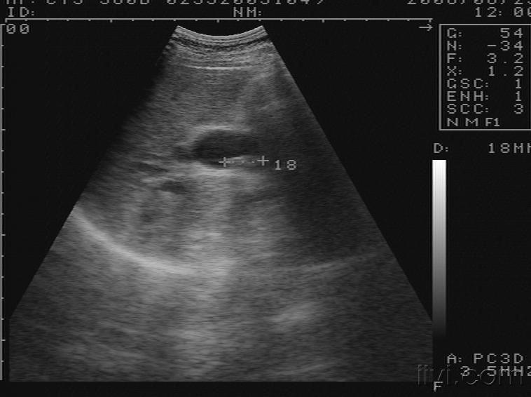 胆囊切除后,胆总管结石 - 超声医学讨论版 - 爱爱医