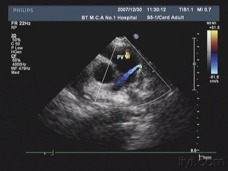 左冠状动脉前降支肺动脉瘘 - 超声医学讨论版 - 爱爱