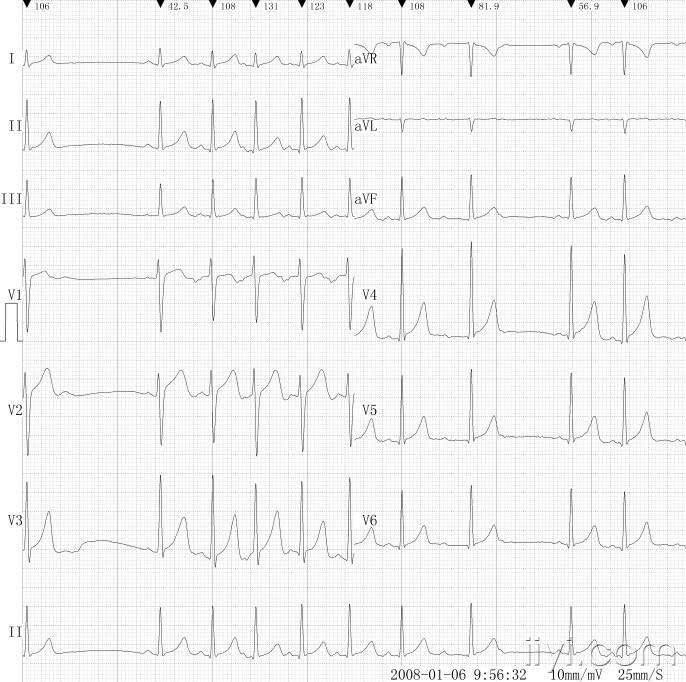 [心电图分析] 窦性停搏?
