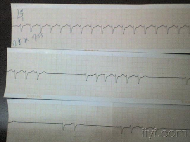 临终时 心电图分享