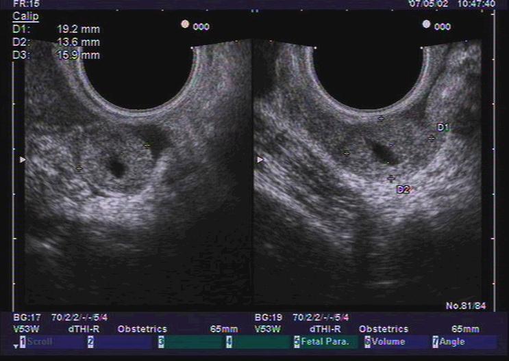 宫外孕典型图 超声医学讨论版 爱爱医医学论坛