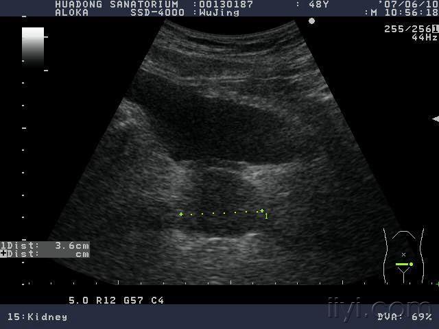 前列腺内这么大的囊肿 超声医学讨论版 爱爱医医学论坛