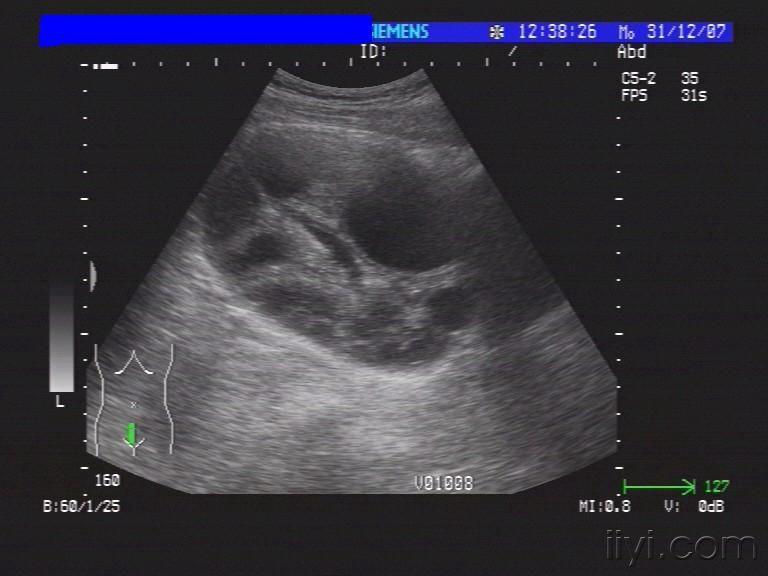 腹腔包虫囊肿