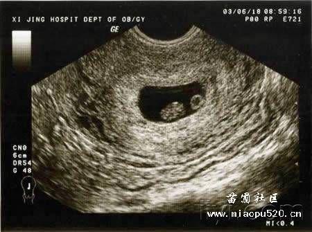 早孕超声图片