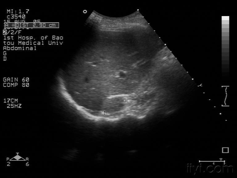 超声检查  超声诊断  放射科  高血压  肾上腺