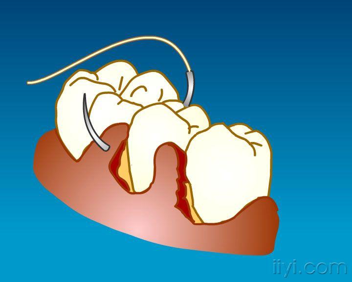 牙周手术缝合方法 口腔医学资源版 爱爱医医学论坛