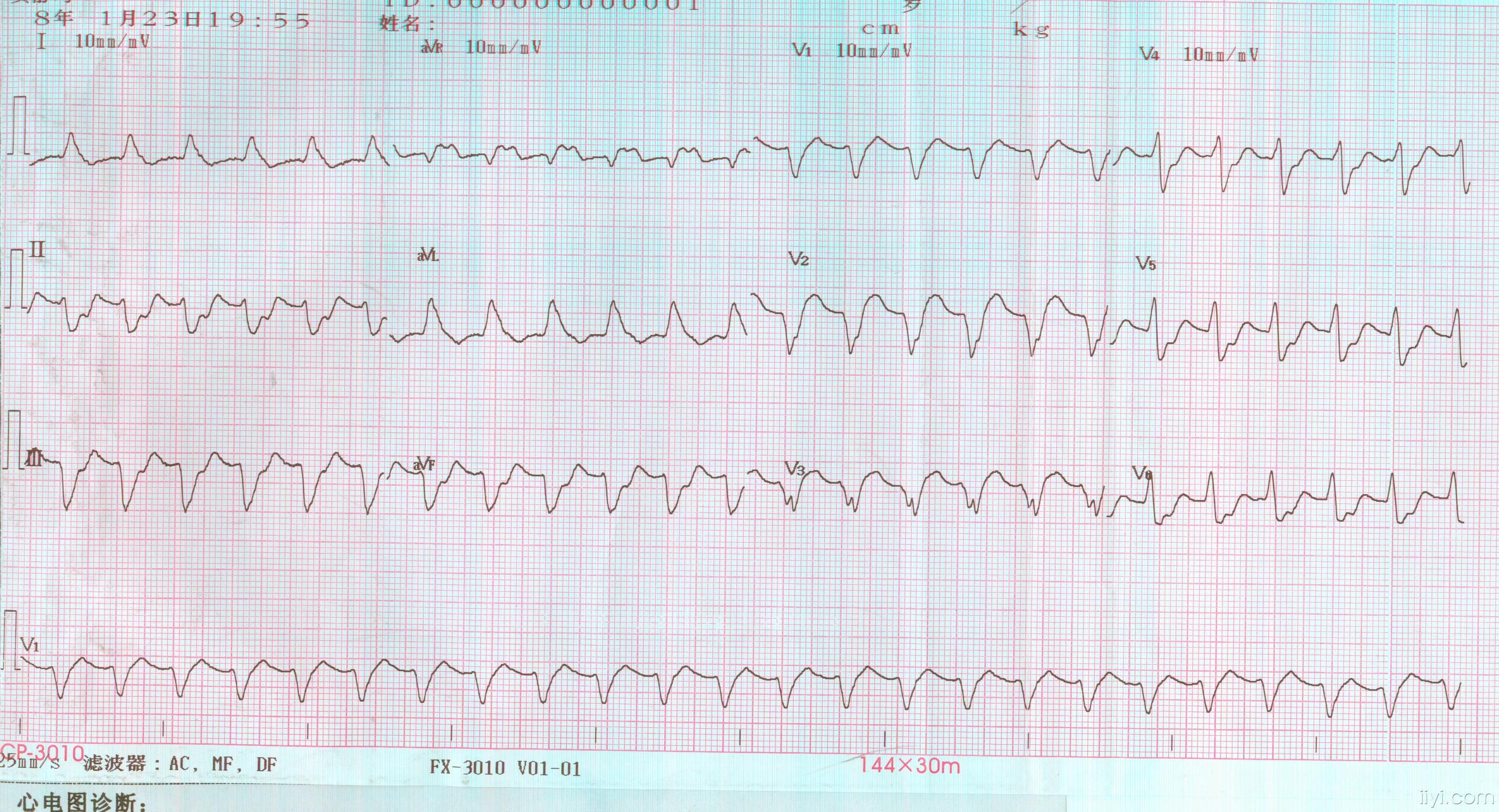 [心电图分析] 室速?室上速?