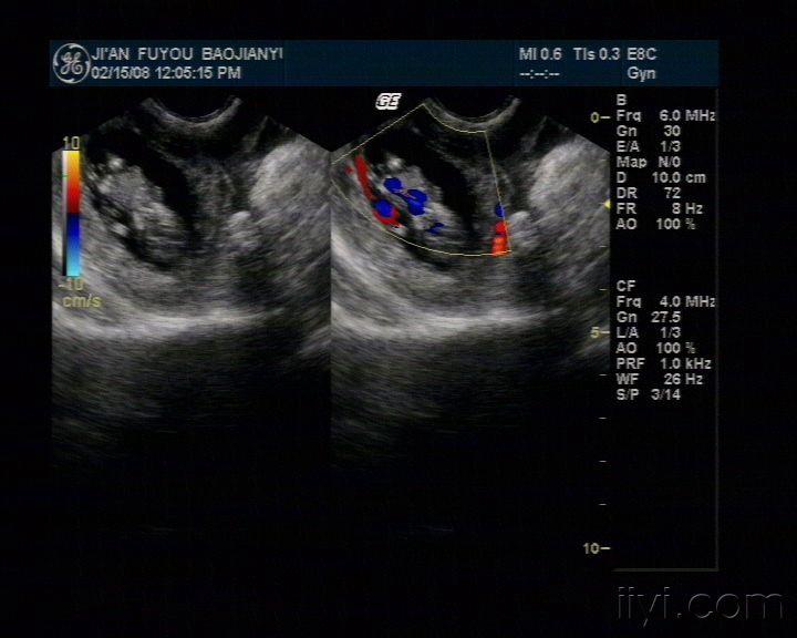 宫外孕 - 超声医学讨论版 - 爱爱医医学论坛