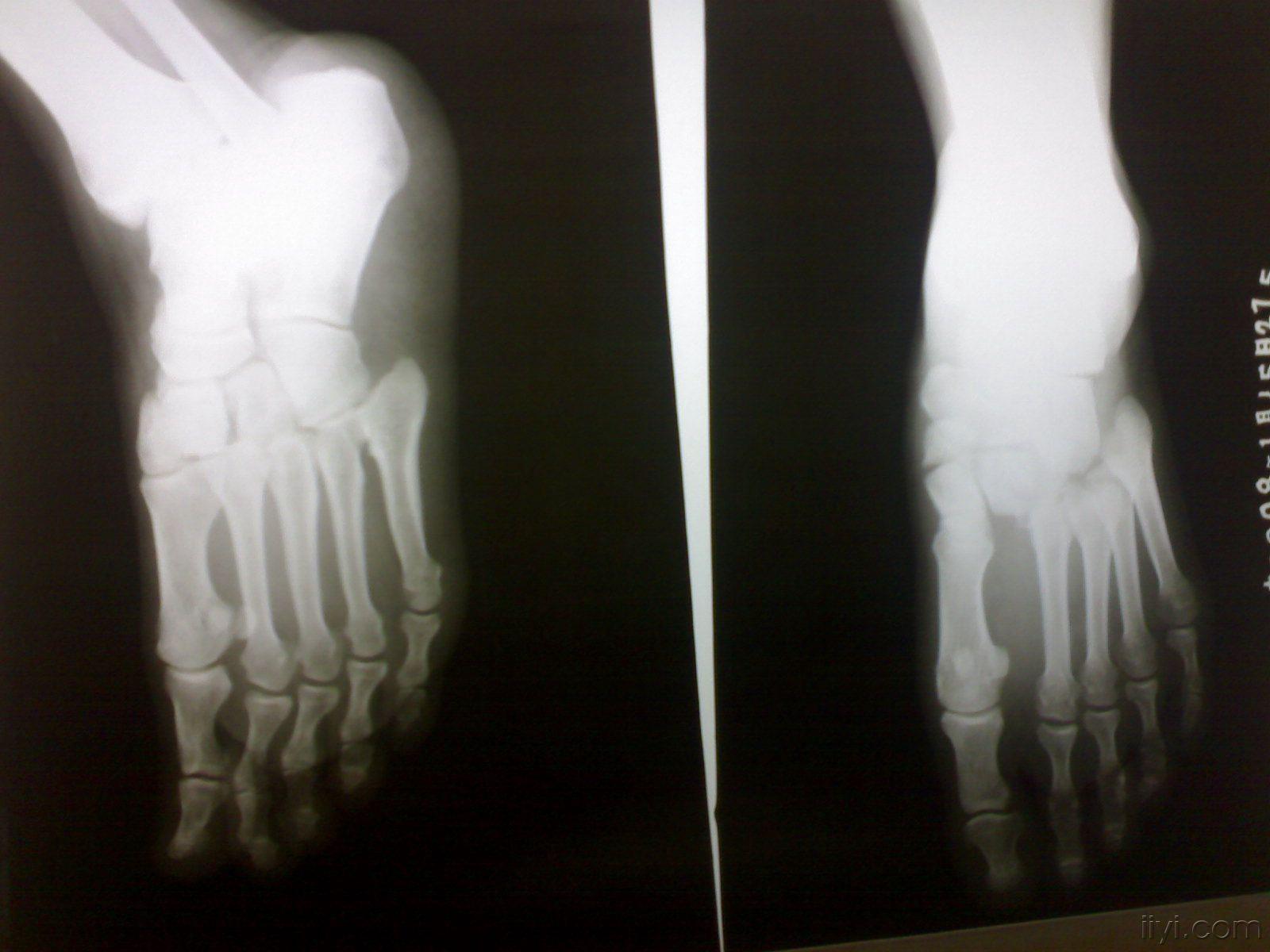 现将近期遇见的1例,常规摄右足正斜位x线片,显示右足跗跖关节跖骨端向
