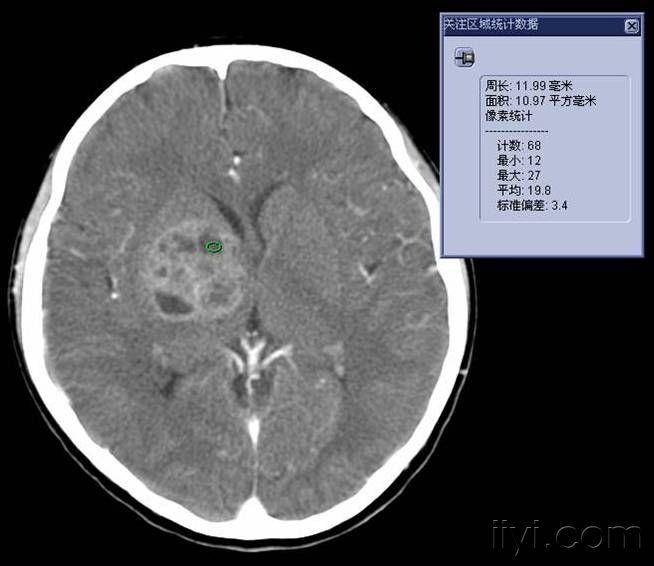 基底节区病变