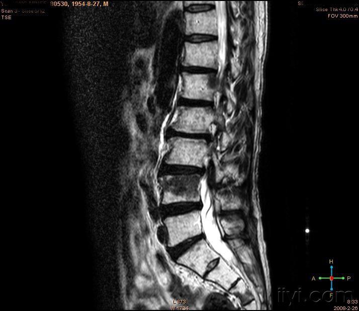 椎体t1t2异常低信号请mri高人讨论